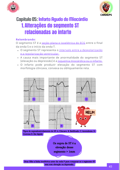 Infarto ECG